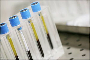 PGRF - Suero Autólogo Enriquecido - VERTE Oftalmología Barcelona