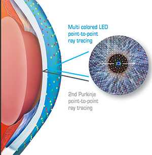 Cassini - Topografía - VERTE Oftalmología Barcelona