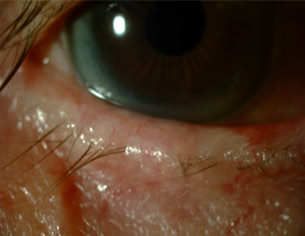 Ojo Seco - VERTE Oftalmología Barcelona