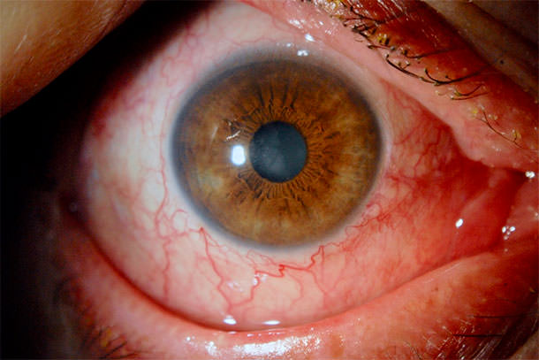 Ojo rojo por intolerancia a colirios hipotensores - VERTE Oftalmología Barcelona