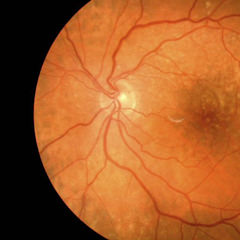 Ecografía Ocular - VERTE Oftalmología Barcelona