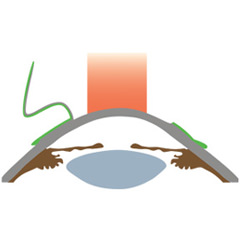 Queratocono - Cirugía refractiva - VERTE Oftalmología Barcelona