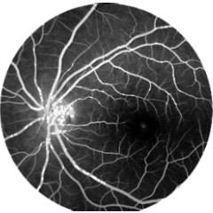 Angiografia fluoresceínica - VERTE Oftalmología Barcelona