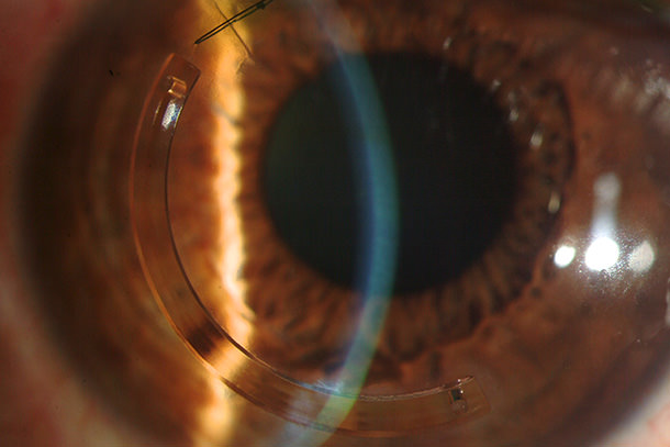 Anillos intraestromales - VERTE Oftalmología Barcelona