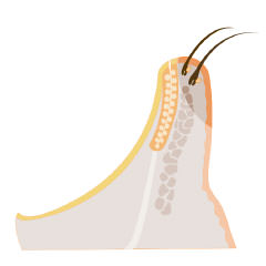 Blefartis - higiene - VERTE Oftalmología Barcelona