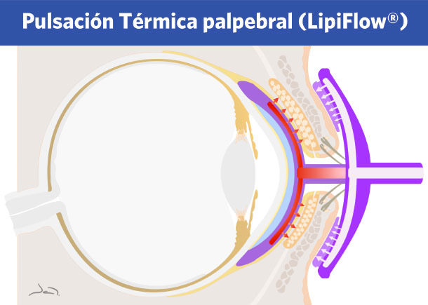 LipiFlow - Blefaritis - VERTE Oftalmología Barcelona LipiFlow - Blefaritis - VERTE Oftalmología Barcelona