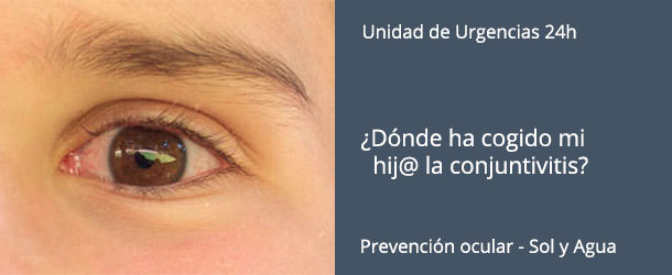 Conjuntivitis - VERTE Oftalmología Barcelona