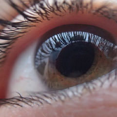 Trasplante de córnea - VERTE Oftalmología Barcelona