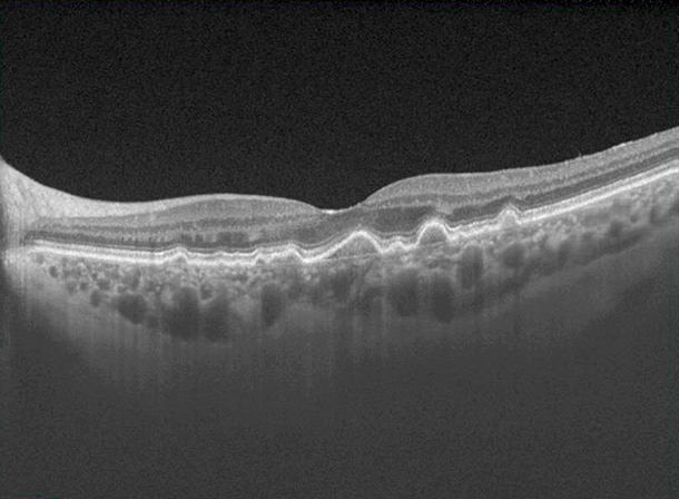 Tomografía de coherencia óptica macular que muestra las ondulaciones en las capas externas de la retina que corresponden a las drusas. DMAE seca - Tratamiento - Tomografía - VERTE Oftalmología Barcelona