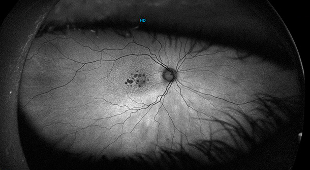 Autofluorescencia de paciente con parches de atrofia retiniana por DMAE seca. Se observan como puntos negros en la zona macular. DMAE SECA - Tratamiento - Autofluorescencia - VERTE Oftalmología Barcelona