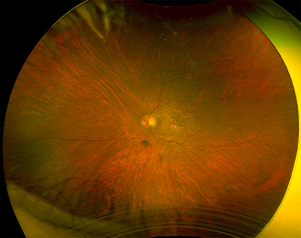 Drusas duras - Optomap Drusas duras - Optomap - VERTE Oftalmología Barcelona