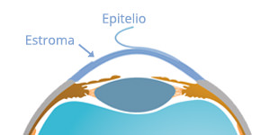 Lámina Superficial - Epitelio - VERTE Oftalmología Barcelona