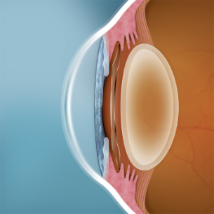 Lentes ICL - VERTE Oftalmología Barcelona