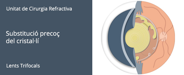 Substitució precoç del Cristal·lí - VERTE Oftalmología Barcelona