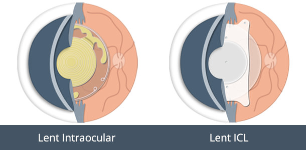 Lents Trifocals versus Lents ICL - VERTE Oftalmología Barcelona