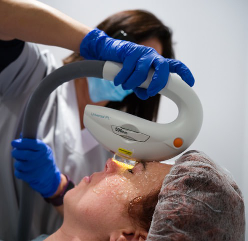 IPL Aplicación - Ojo seco - Dra. Cristina Vendrell - VERTE Oftalmología Barcelona