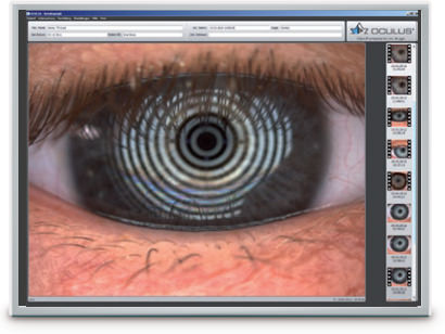 Capa Lipídica - Keratograph 5M - VERTE Oftalmología Barcelona