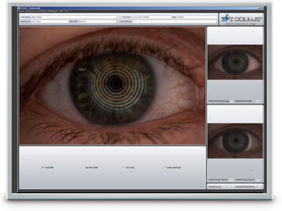 Enrojecimiento - Keratograph 5M - VERTE Oftalmología Barcelona