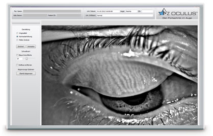 Meibografía - Keratograph 5M - VERTE Oftalmología Barcelona