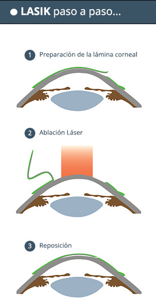 Cirugía LASIK Paso a Paso - VERTE Oftalmología Barcelona