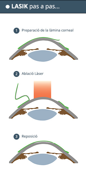 LASIK pas a pas - VERTE Oftalmología Barcelona