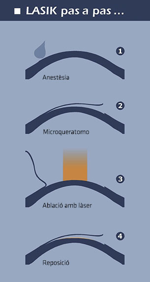 CIrugia LASIK Pas a pas - VERTE Oftalmología Barcelona