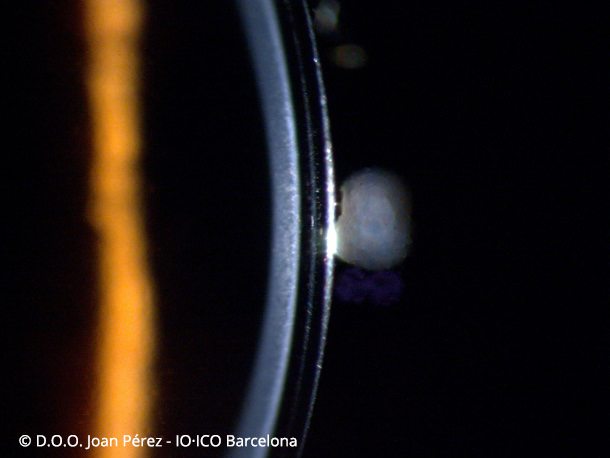 Lente Escleral - D.O.O. Joan Pérez - VERTE Oftalmología Barcelona