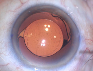 Lente monofocal tórica - VERTE Oftalmología Barcelona