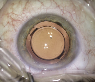 Lentes Trifocales - VERTE Oftalmología Barcelona