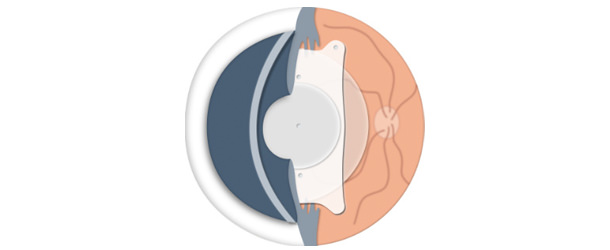 Lentes ICL - VERTE Oftalmología Barcelona