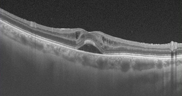 OCT - Retina - VERTE Oftalmología Barcelona