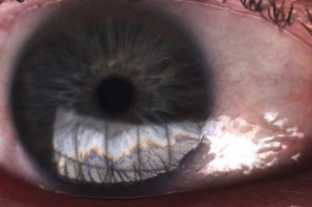 Ojo Seco - VERTE Oftalmología Barcelona