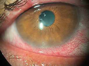 Orugas - Ojo - VERTE Oftalmología Barcelona