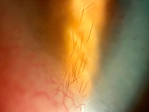 Espina orugas ojos - VERTE Oftalmología Barcelona