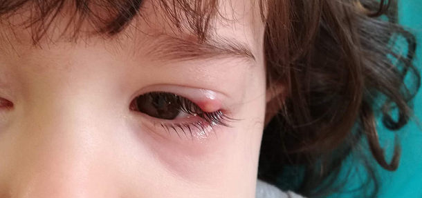 Orzuelo - VERTE Oftalmología Barcelona