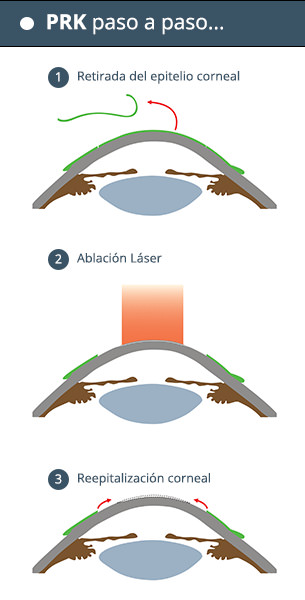 PRK paso a paso - VERTE Oftalmología Barcelona