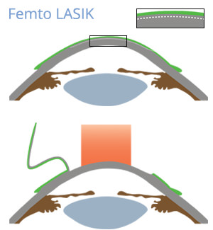 Femto LASIK - VERTE Oftalmología Barcelona