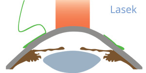 LASIK - VERTE Oftalmología Barcelona