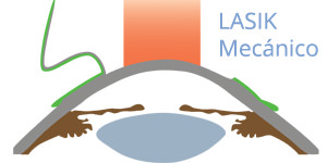 LASIK Mecánico - VERTE Oftalmología Barcelona