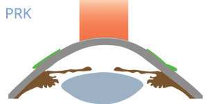 PRK - VERTE Oftalmología Barcelona