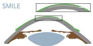 SMILE - VERTE Oftalmología Barcelona
