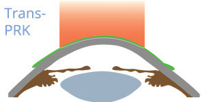 Trans PRK - VERTE Oftalmología Barcelona