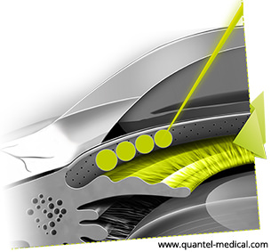 Trabeculoplastia Láser Selectiva - SLT- VERTE Oftalmología Barcelona