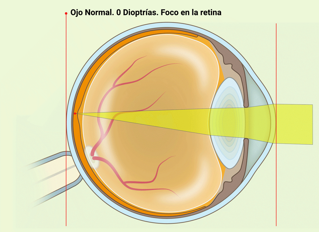 Astigmatismo - VERTE Oftalmologia Barcelona