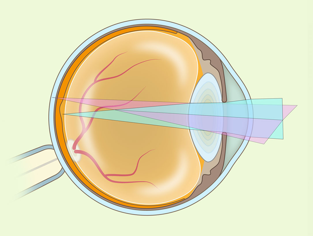 Qué es el astigmatismo y cómo se trata