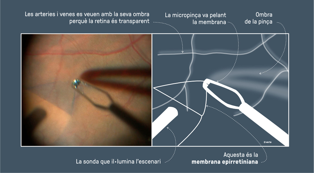 Cirurgia Macular - VERTE Oftalmologia Barcelona
