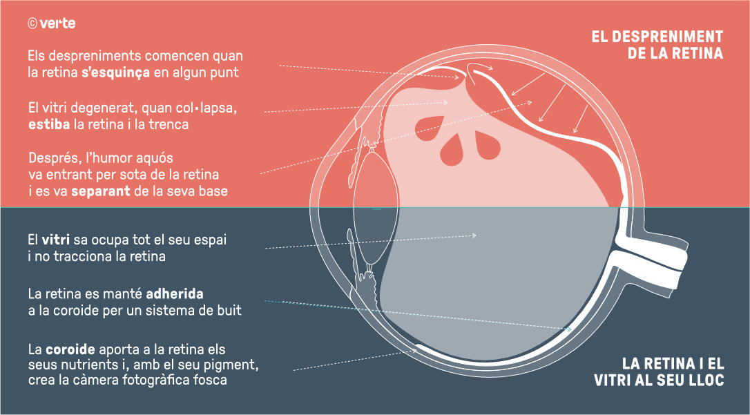Despreniment de retina - VERTE Oftalmologia Barcelona