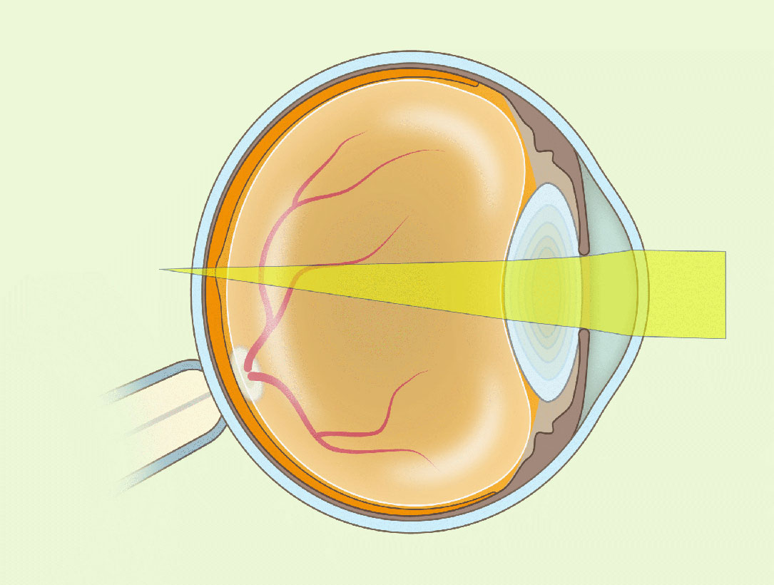 Qué es la hipermetropía y cómo se trata