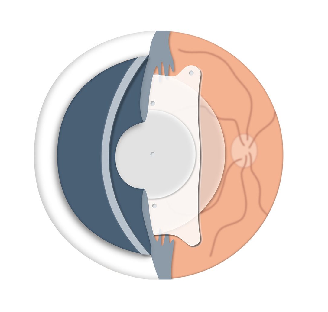 Implantació Lentes ICL - Miopia - VERTE Oftalmologia Barcelona