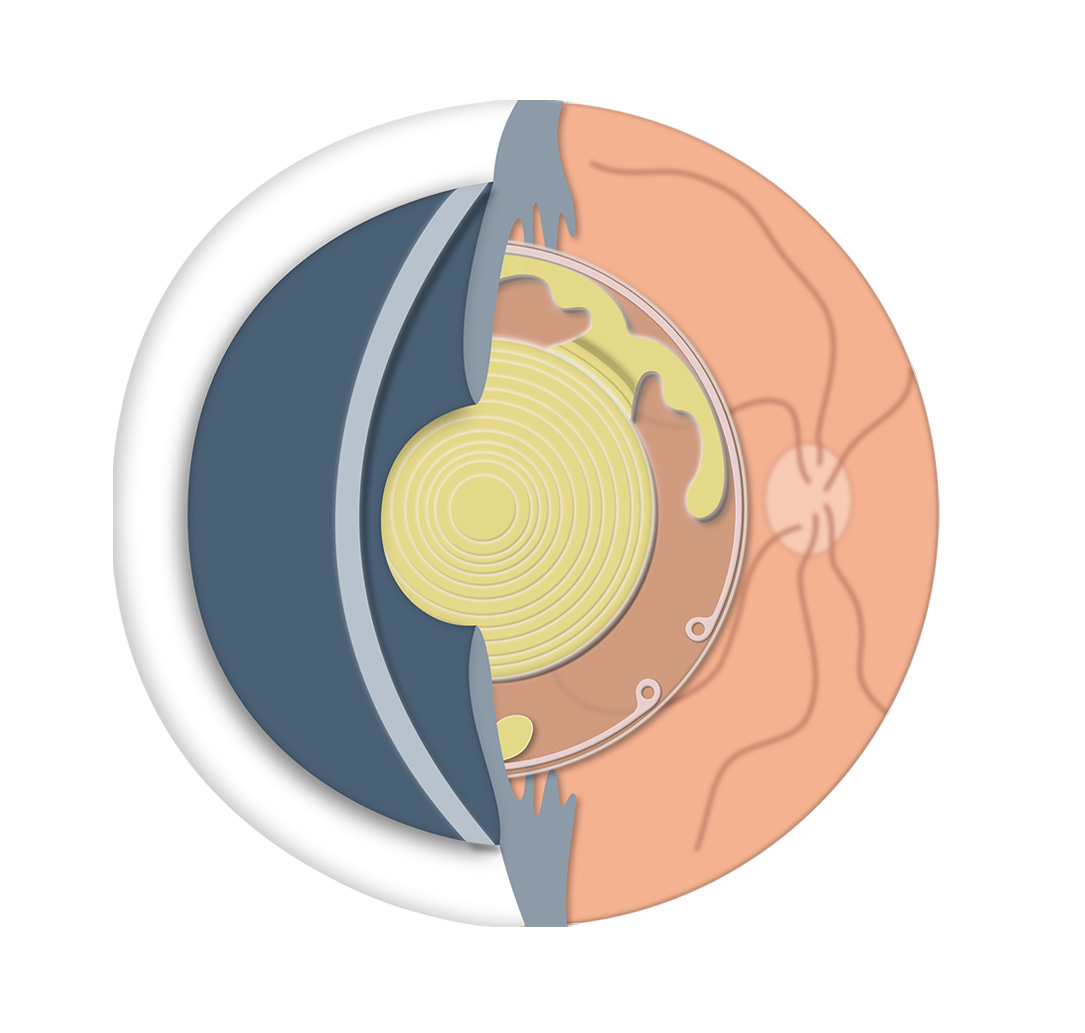 Implantació Lents Trifocals - VERTE Oftalmologia Barcelona